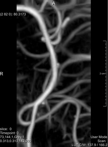 Vessel Enhancing Diffusion