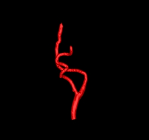 Nearly automatic vessels segmentation using graph-based energy minimization